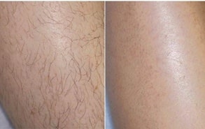 laser hair removal