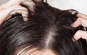 Dandruff