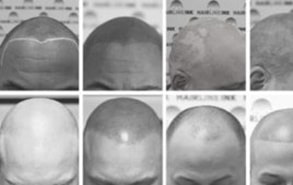 Scalp Micro