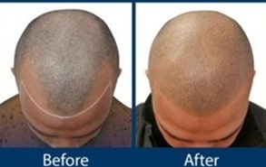 Hair Transplant (FUE)