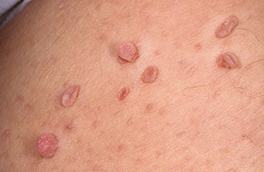 skintag